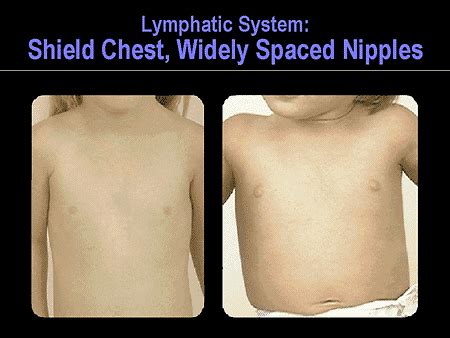 what causes a third nipple|Supernumerary Nipple: Causes, Diagnosis, and Images